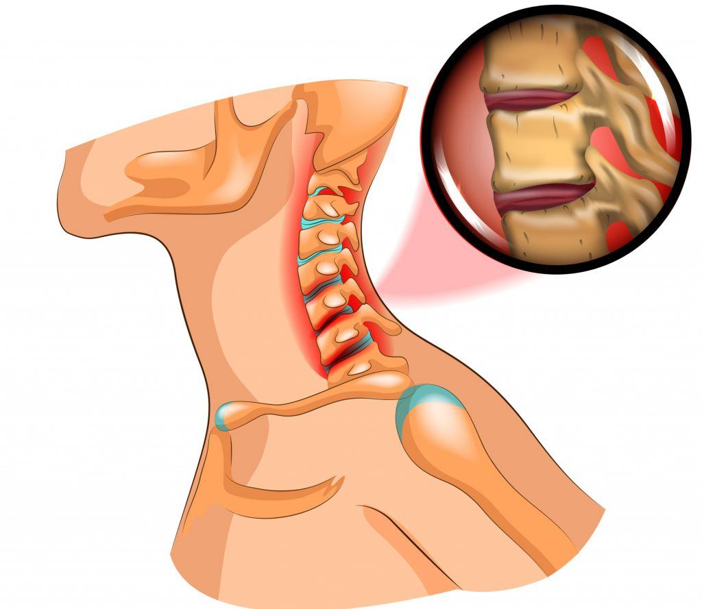 vervormen Mammoet werk Artrose in Nek-Symptomen, Oorzaken & Behandeling | Livit Orthopedie