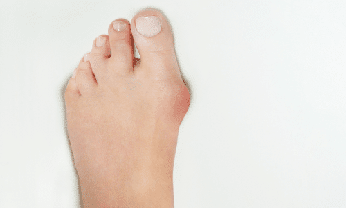 Hallux Valgus Oorzaken Symptomen Behandeling Livit Ottobock